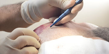 Hair Transplants and Confidence: A UK Perspective